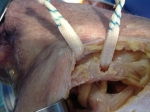 4. LIGAMENTOPLASTIA ANATÓMICA PARA LUXACIÓN ACROMIO-CLAVICULAR. FOTOGRAFÍA EN PIEZA CADAVÉRICA