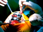 7. PRÓTESIS TOTAL DE RODILLA